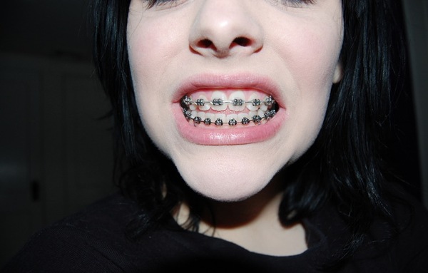 tanden