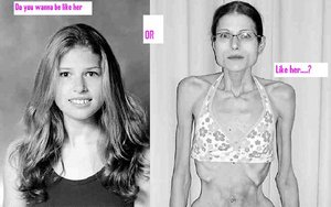 gevolgen anorexia