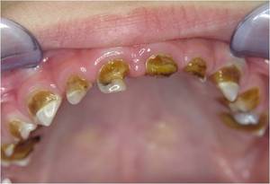 caries boulimia anorexia tanden 