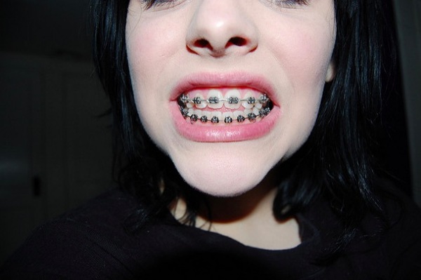 Ik had tanden - Beautyblog - Proud2bme