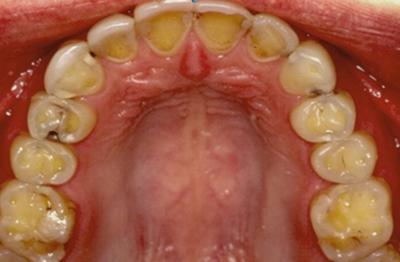 tanden boulimia